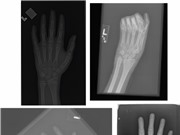 Đánh giá tuổi xương của trẻ em qua ảnh X-quang bằng AI